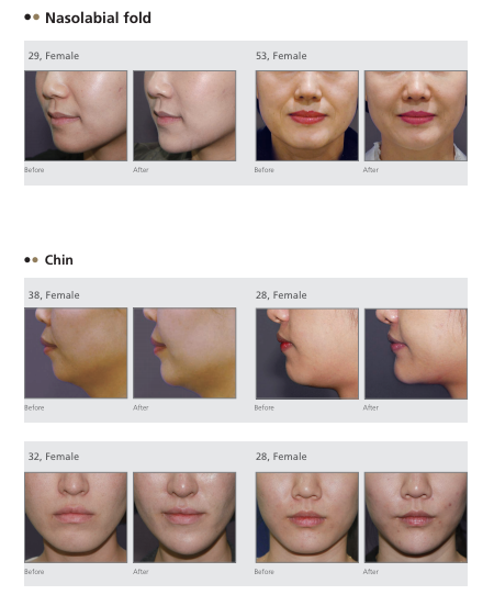 Neuramis fillers before and after chin