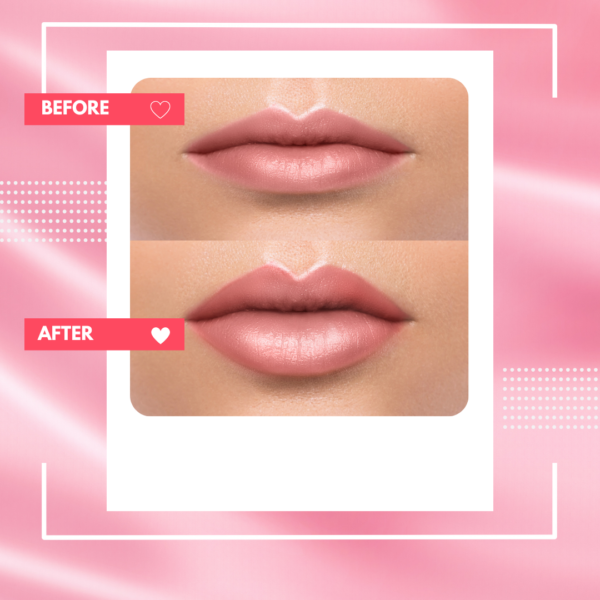 Before and after using Korean dermal fillers on lips and cheeks.